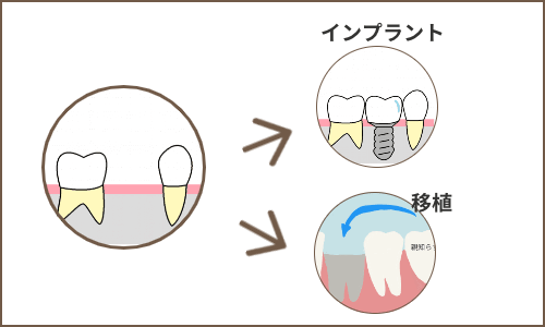 移植