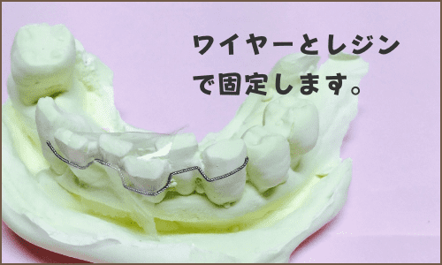歯 の ぐらつき 固定