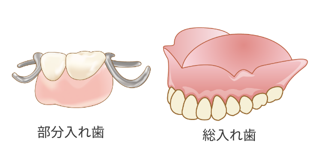 入れ歯治療|高崎市 すまいる歯科 伊東醫院