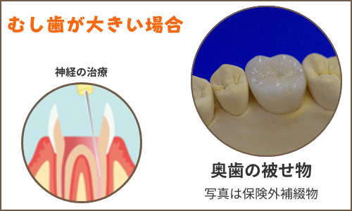 奥歯被せ物