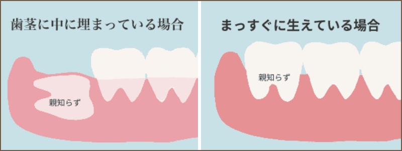 親知らず生え方