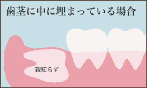 親知らず つれ舌 歯根嚢胞 高崎市 すまいる歯科 伊東醫院 親知らず つれ舌 歯根嚢胞 高崎市 すまいる歯科 伊東醫院