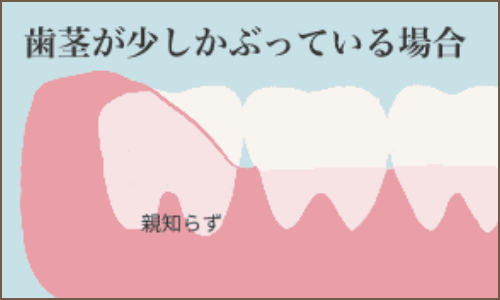親知らず つれ舌 歯根嚢胞 高崎市 すまいる歯科 伊東醫院 親知らず つれ舌 歯根嚢胞 高崎市 すまいる歯科 伊東醫院