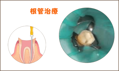 ラバーダム使用した根管治療