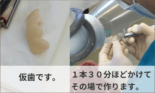 仮歯製作