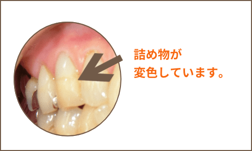 詰め物の変色