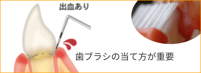 歯茎(歯周ポケット)から出血