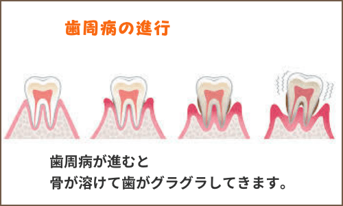 歯周病進行具合