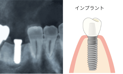 インプラントのデンタル