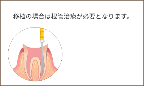 根管治療