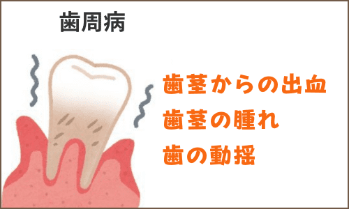 歯の動揺腫れ
