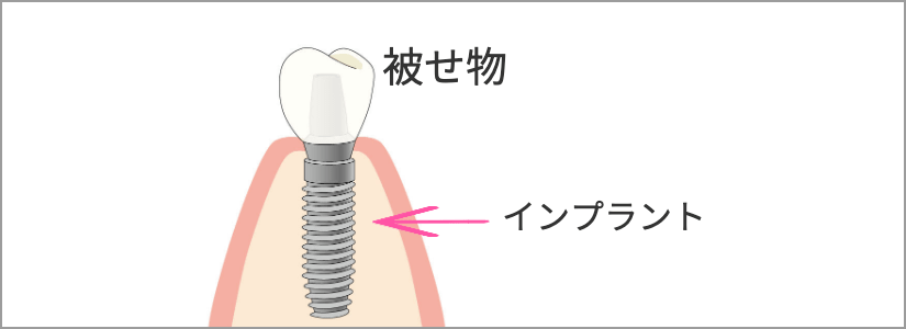 インプラント