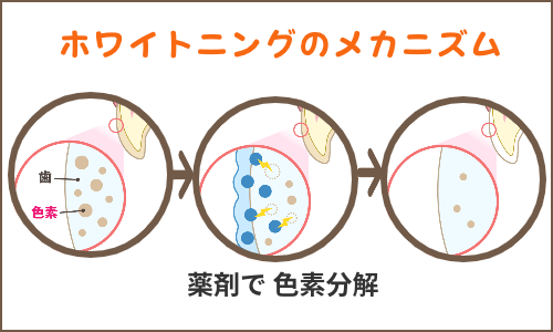 ホワイトニングの選び方 ホワイトニングの種類とオススメと違いは 群馬県高崎市すまいる歯科 伊東醫院
