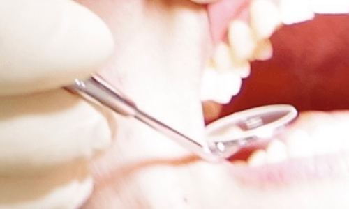 予防歯科 高崎市スマイル歯科クリニック