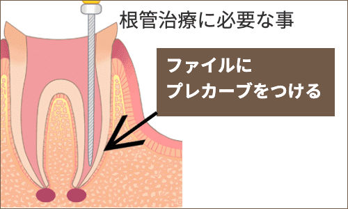 根管治療に必要な事