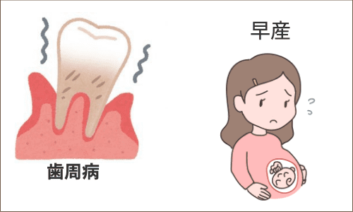 歯周病と早産